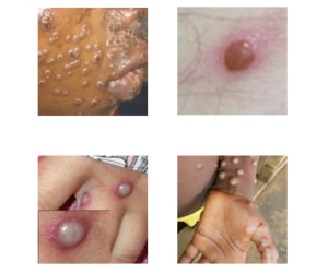 Monkeypox mpox south africa whatsup doc online doctor whatsapp