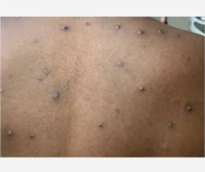 mpox monkeypox south africa whatsup doc online doctor whatsapp